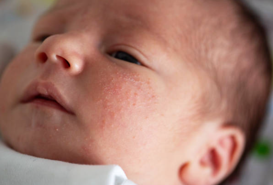 Naturalne sposoby na potówki u niemowląt